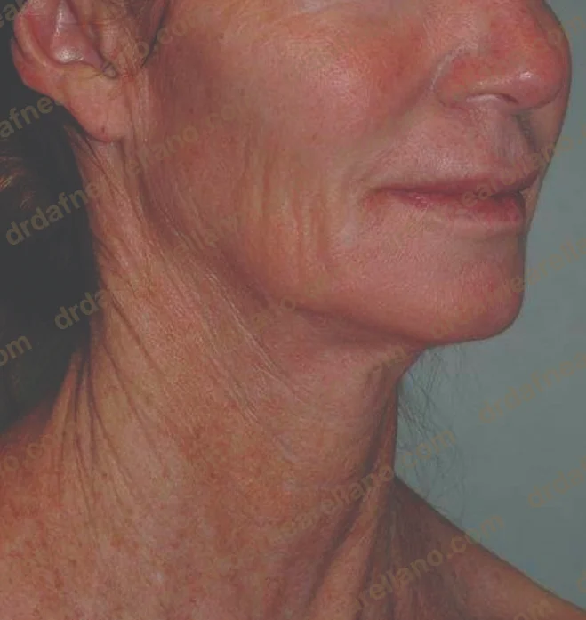 Antes — Tratamiento de Flacidez Facial en Puebla