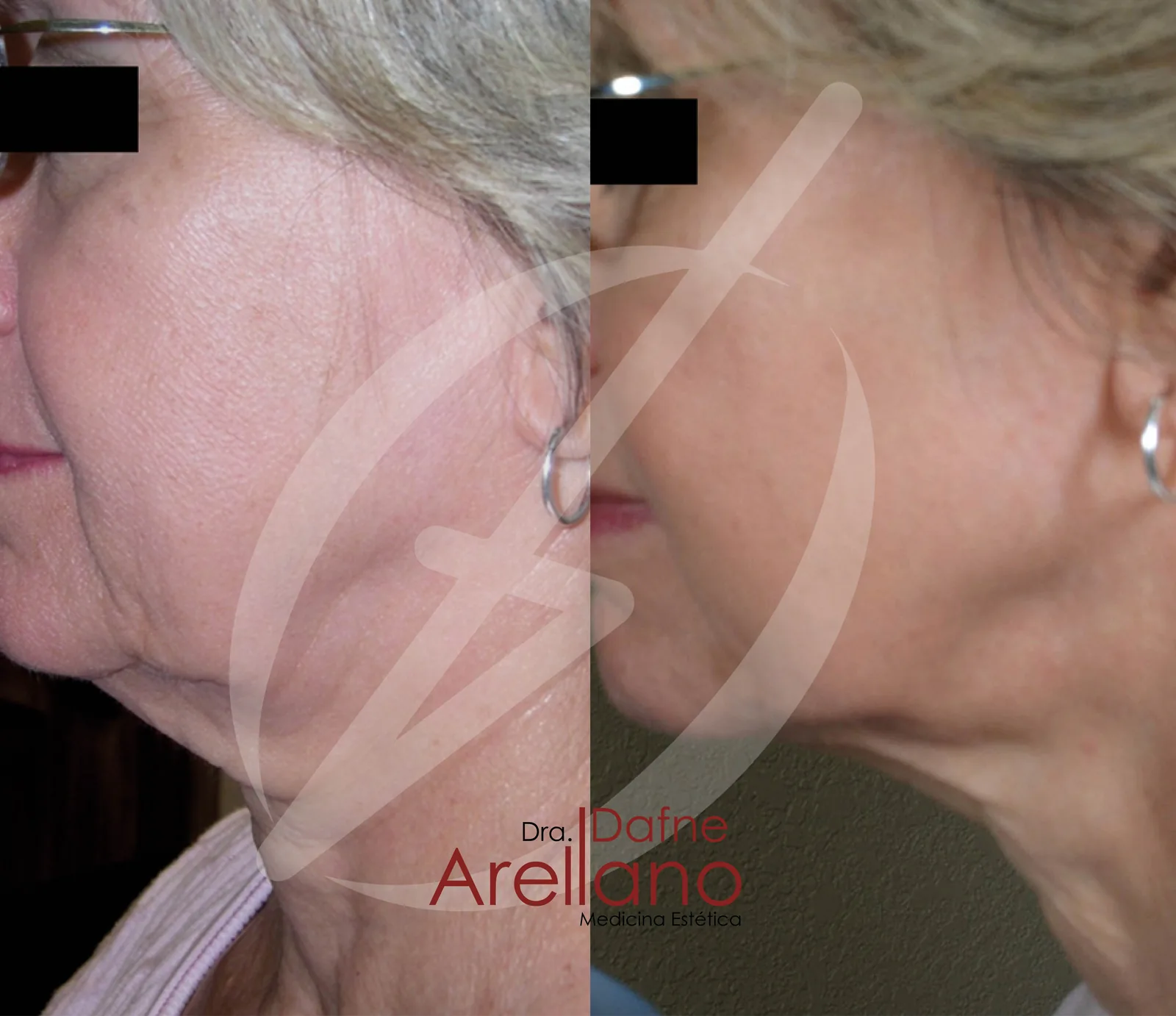Antes — Tratamiento de Flacidez Facial en Puebla