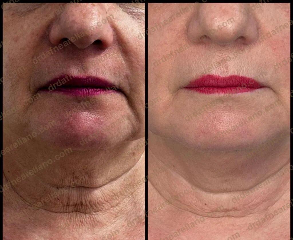 Antes y después — Tratamiento de Flacidez Facial en Puebla
