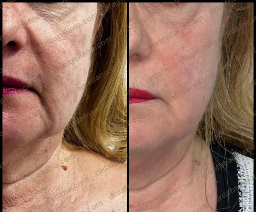 Antes y después — Tratamiento de Flacidez Facial en Puebla