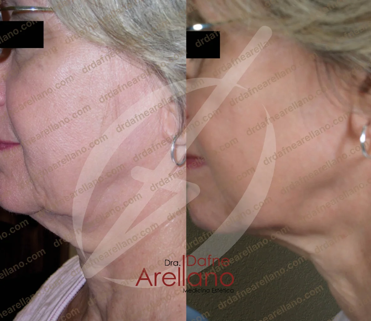 Antes y después — Tratamiento de Flacidez Facial en Puebla