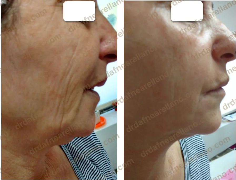 Antes y después — Tratamiento de Flacidez Facial en Puebla