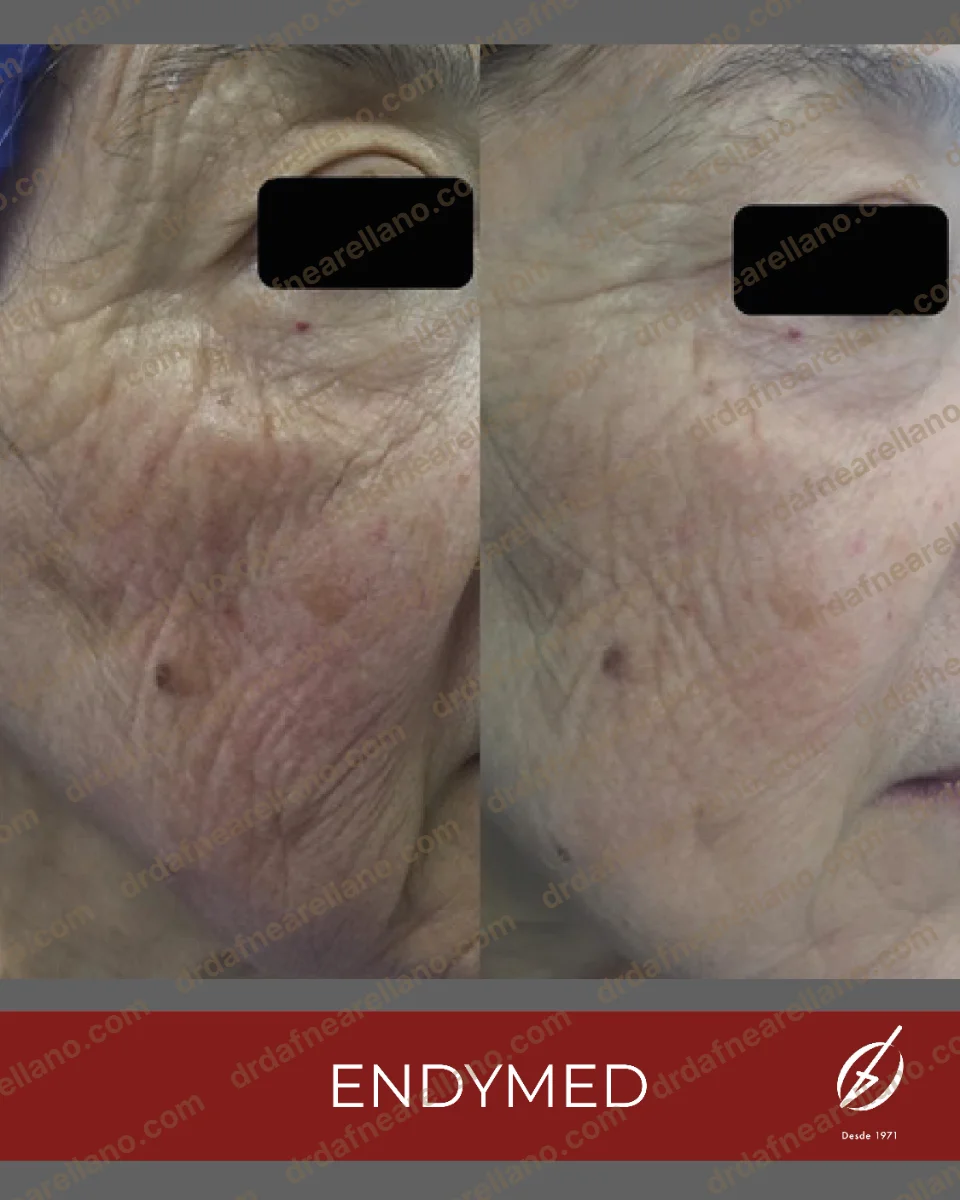 Antes y después — Tratamiento de Flacidez Facial en Puebla