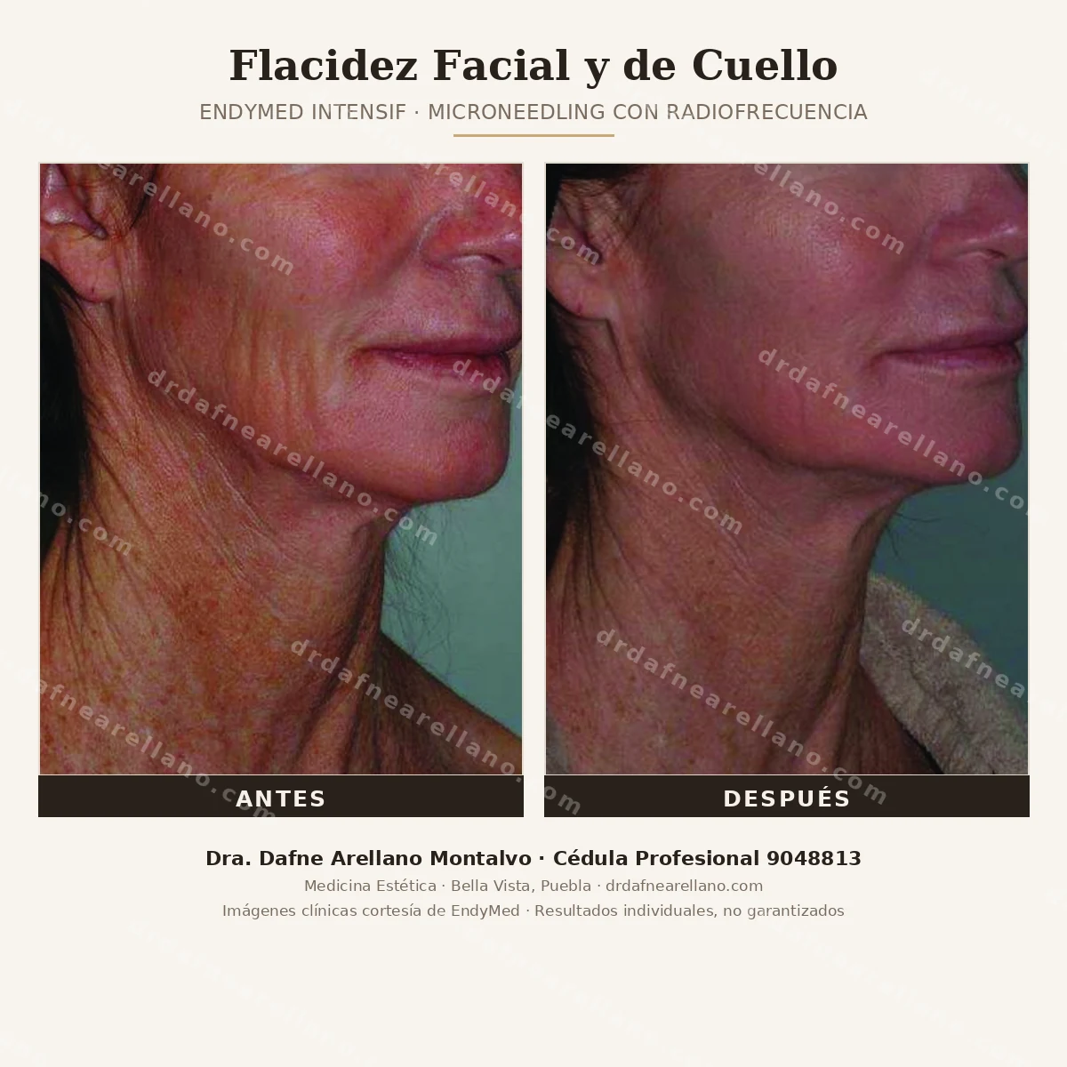 Flacidez facial y de cuello tratada con EndyMed Intensif (microneedling con radiofrecuencia) — antes y despues. Tensado del ovalo facial y cuello sin cirugia. Dra. Dafne Arellano Montalvo, Puebla.