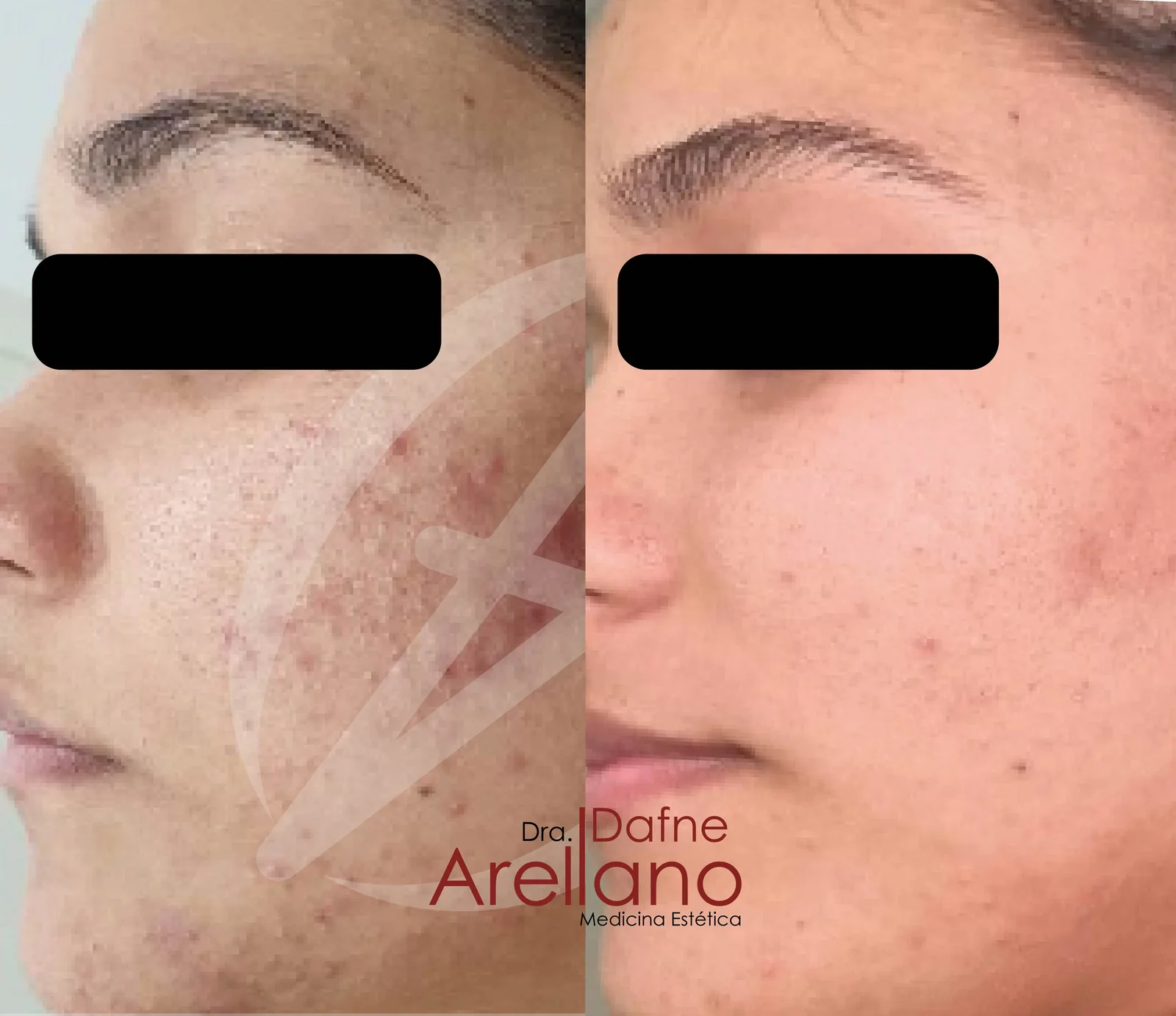 Después — Geneo Facial Oxigenante en Puebla