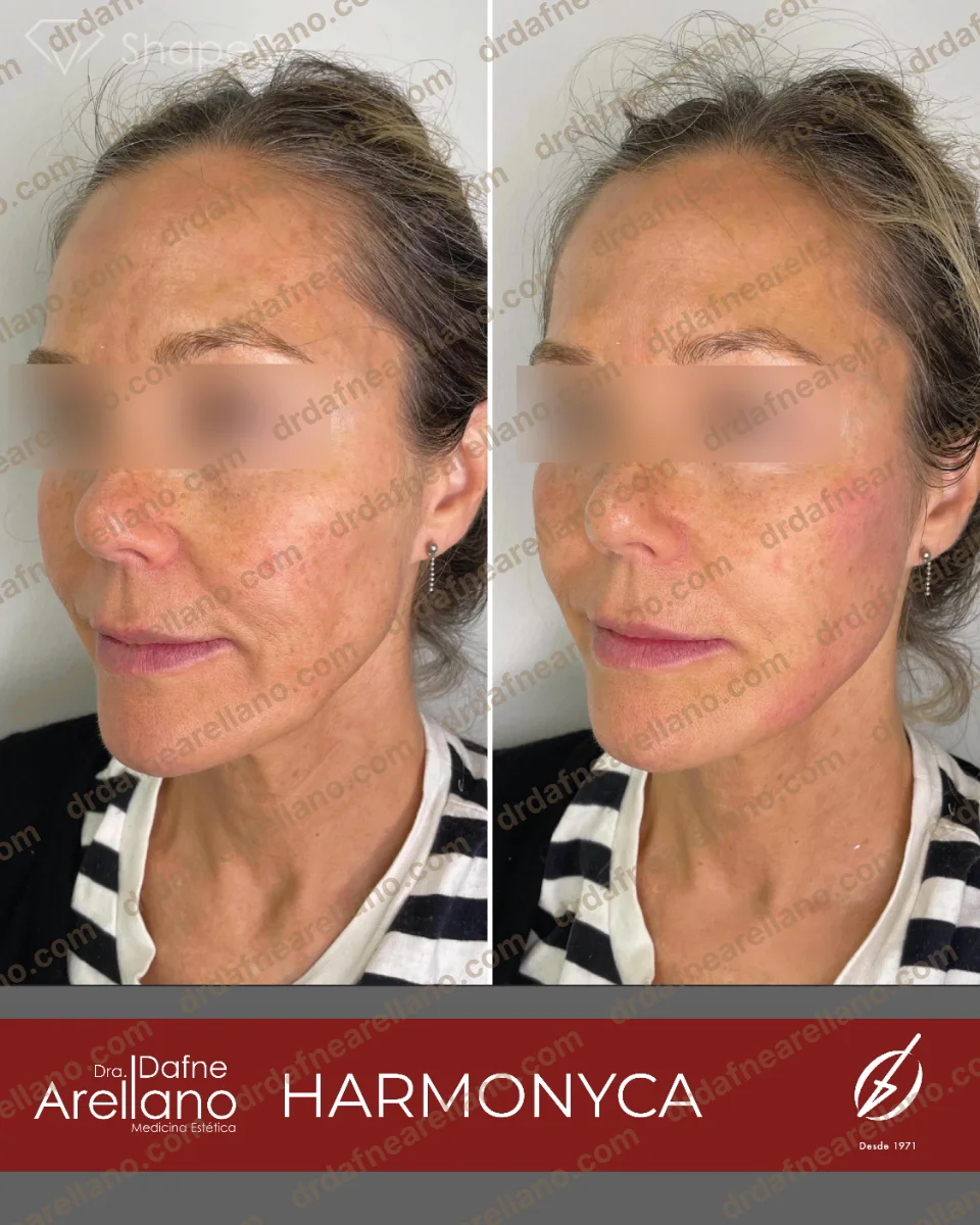 Antes y después — HArmonyCa en Puebla