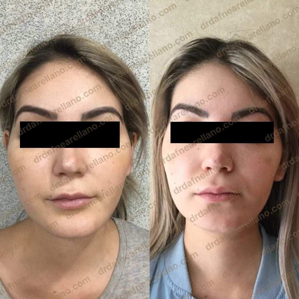 Antes y después — HArmonyCa en Puebla