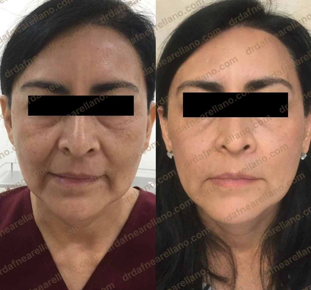 Antes y después — HArmonyCa en Puebla