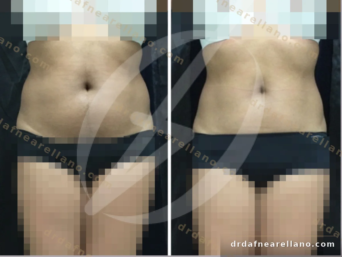 Antes y después — Hidrolipoclasia HIFU en Puebla