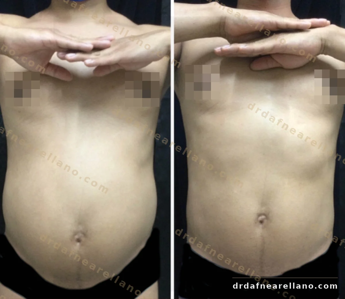 Antes y después — Hidrolipoclasia HIFU en Puebla