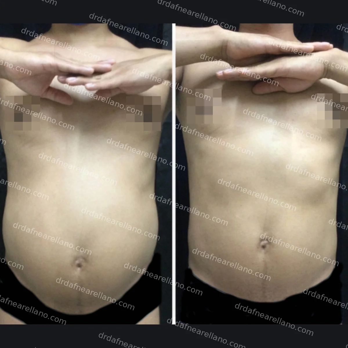 Hidrolipoclasia + HIFU en Puebla — resultado antes y despues en abdomen. Protocolo de 1 sesion de hidrolipoclasia y 3 sesiones de HIFU, una por semana. Dra. Dafne Arellano Montalvo, Cedula Profesional 9048813, Bella Vista, Puebla. Julio 2026.