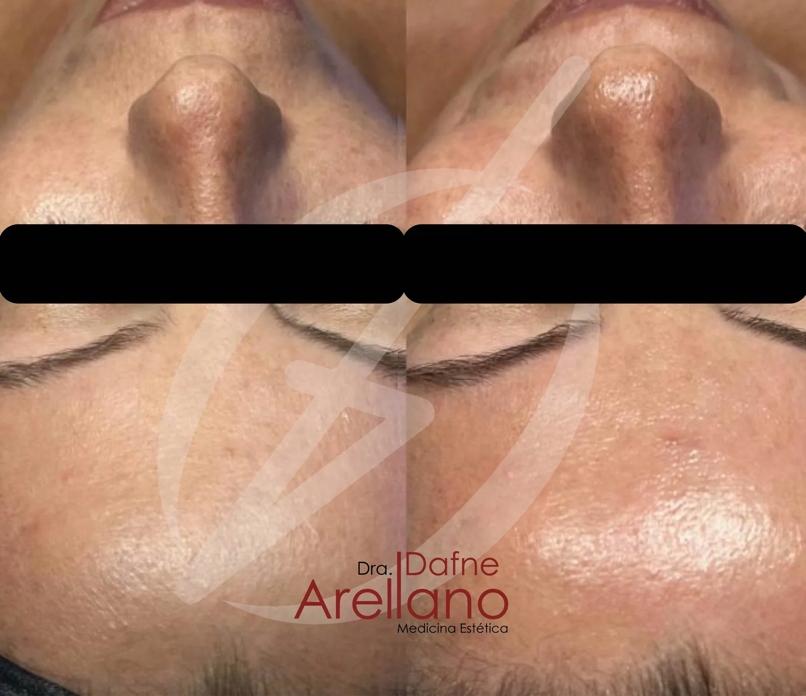 Después — HydraFacial JLO Beauty Booster en Puebla
