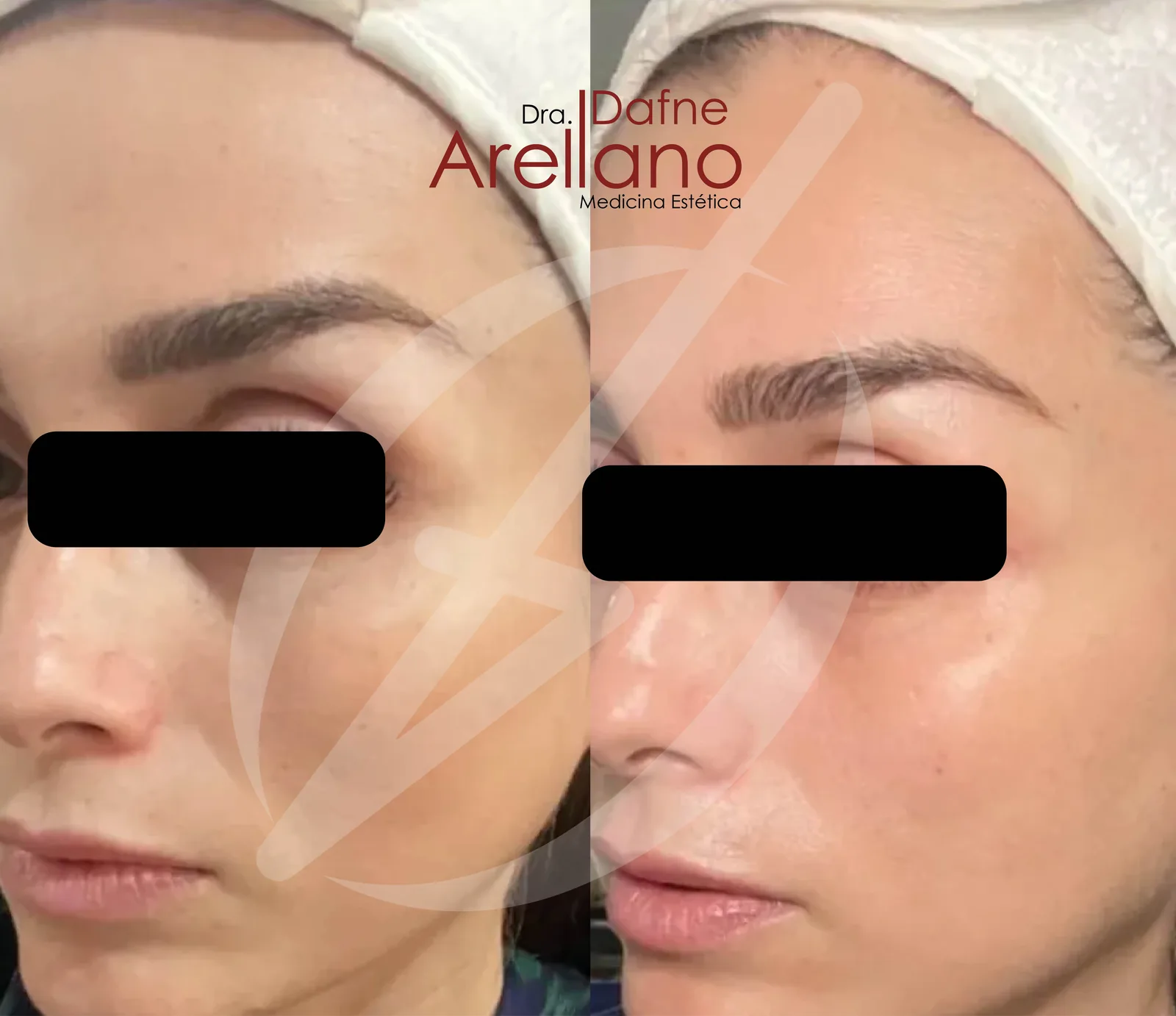 Antes — HydraFacial JLO Beauty Booster en Puebla
