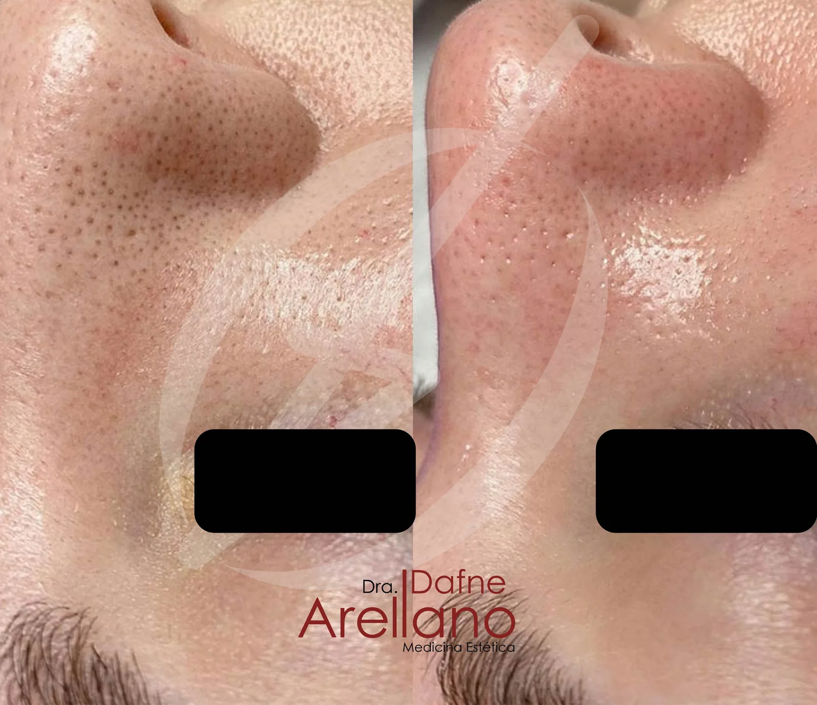 Después — HydraFacial en Puebla