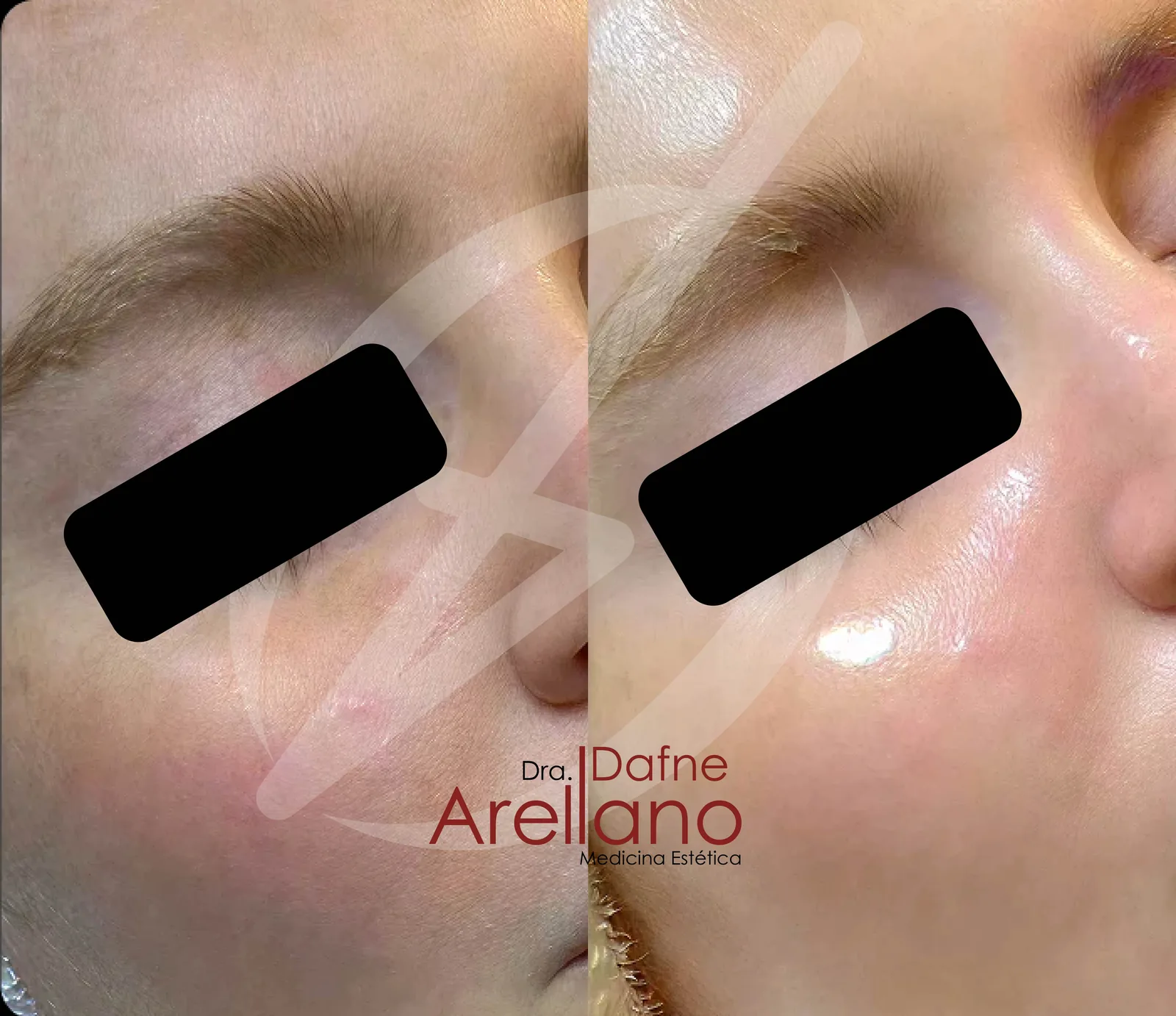 Antes — HydraFacial en Puebla
