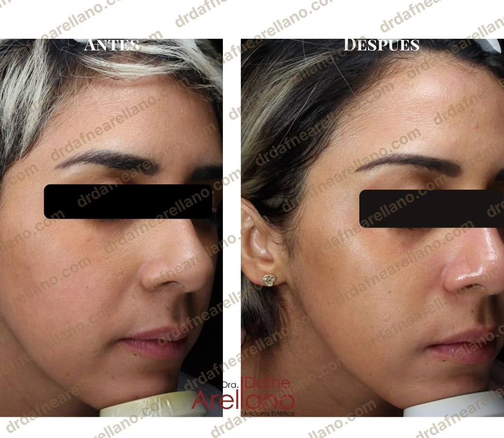 Antes y después — HydraFacial en Puebla