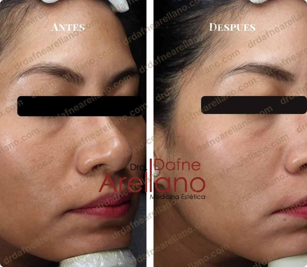 Antes y después — HydraFacial en Puebla
