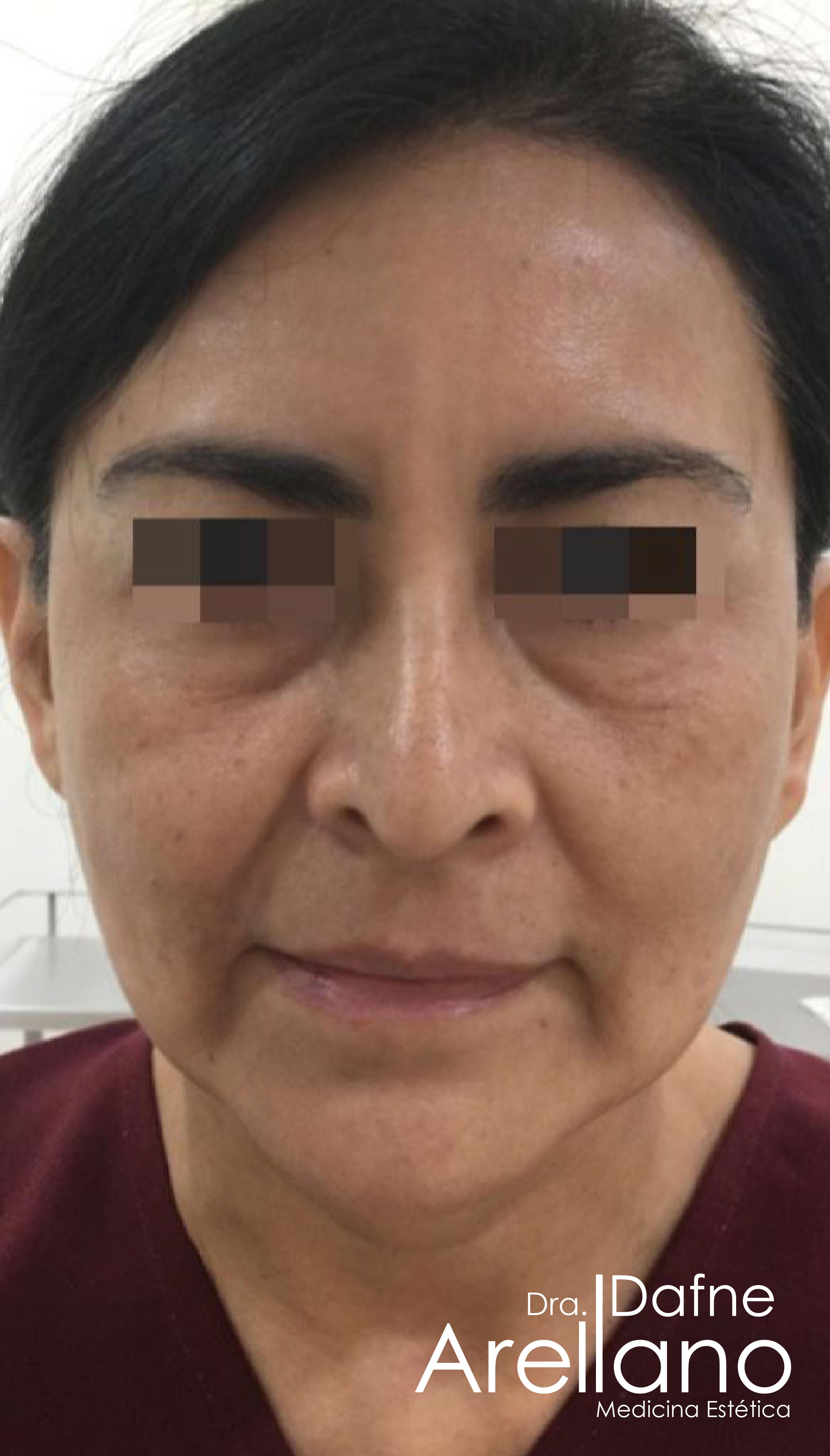 Antes — Armonización Facial en Puebla