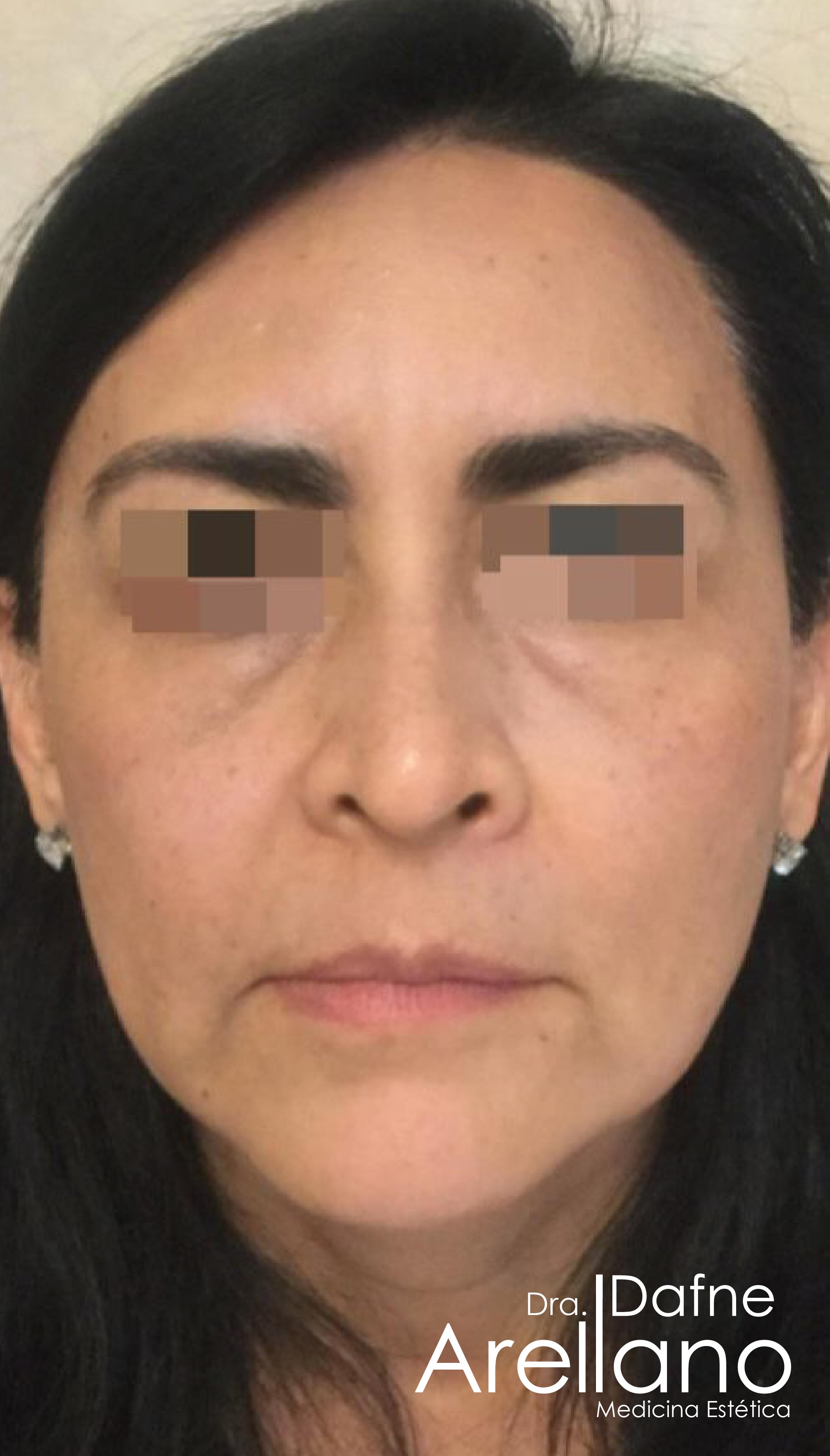 Después — Armonización Facial en Puebla