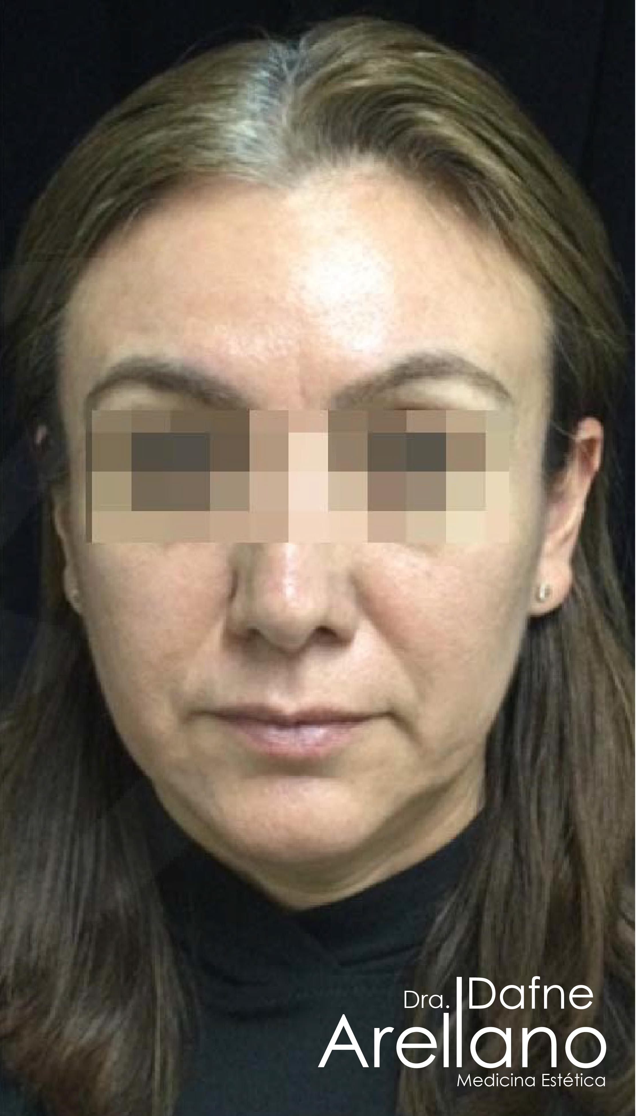 Antes — Botox en Puebla – Toxina Botulínica con Resultados Naturales