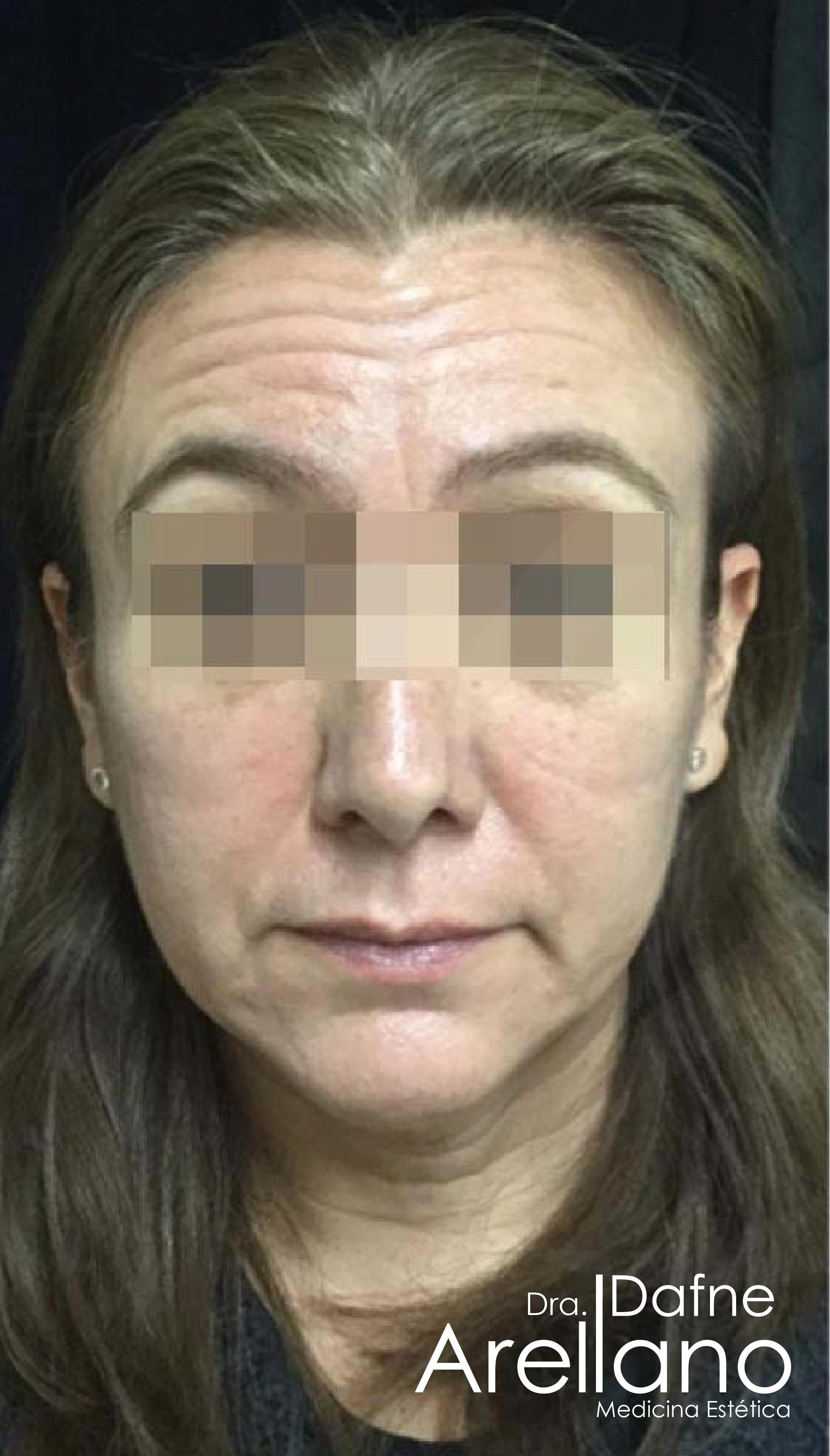 Después — Botox en Puebla – Toxina Botulínica con Resultados Naturales