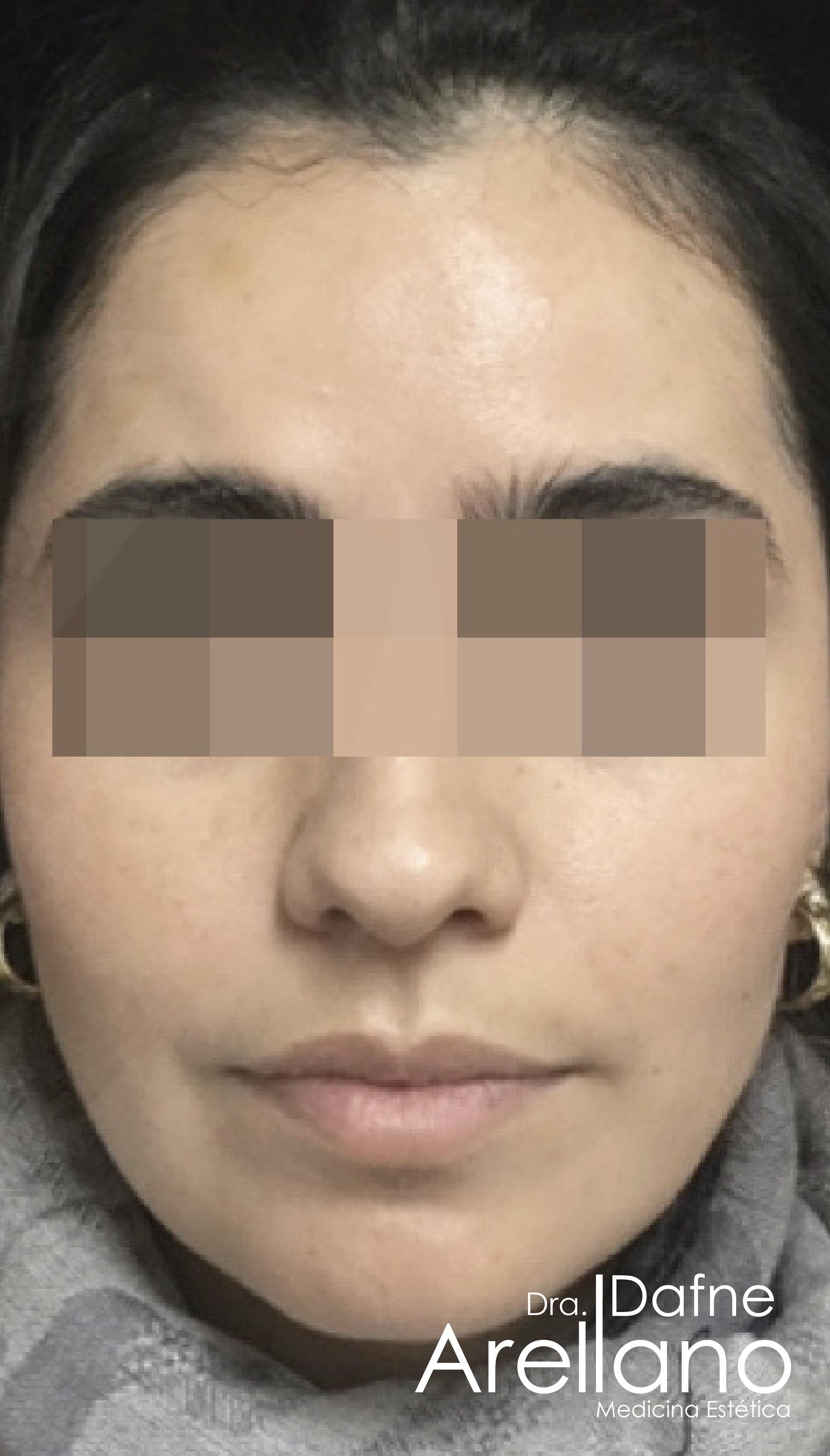 Después — Botox en Puebla – Toxina Botulínica con Resultados Naturales