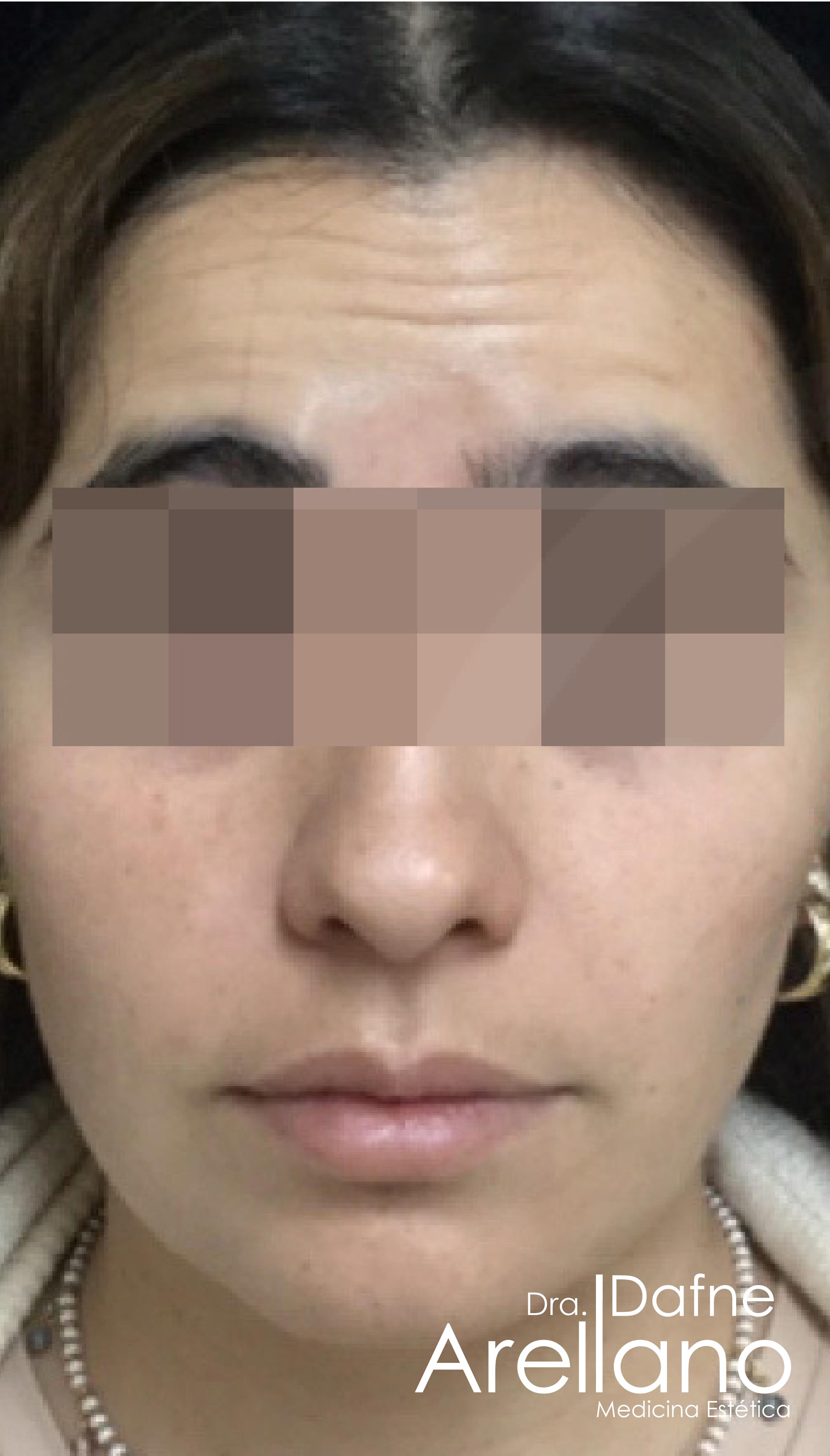 Antes — Botox en Puebla – Toxina Botulínica con Resultados Naturales