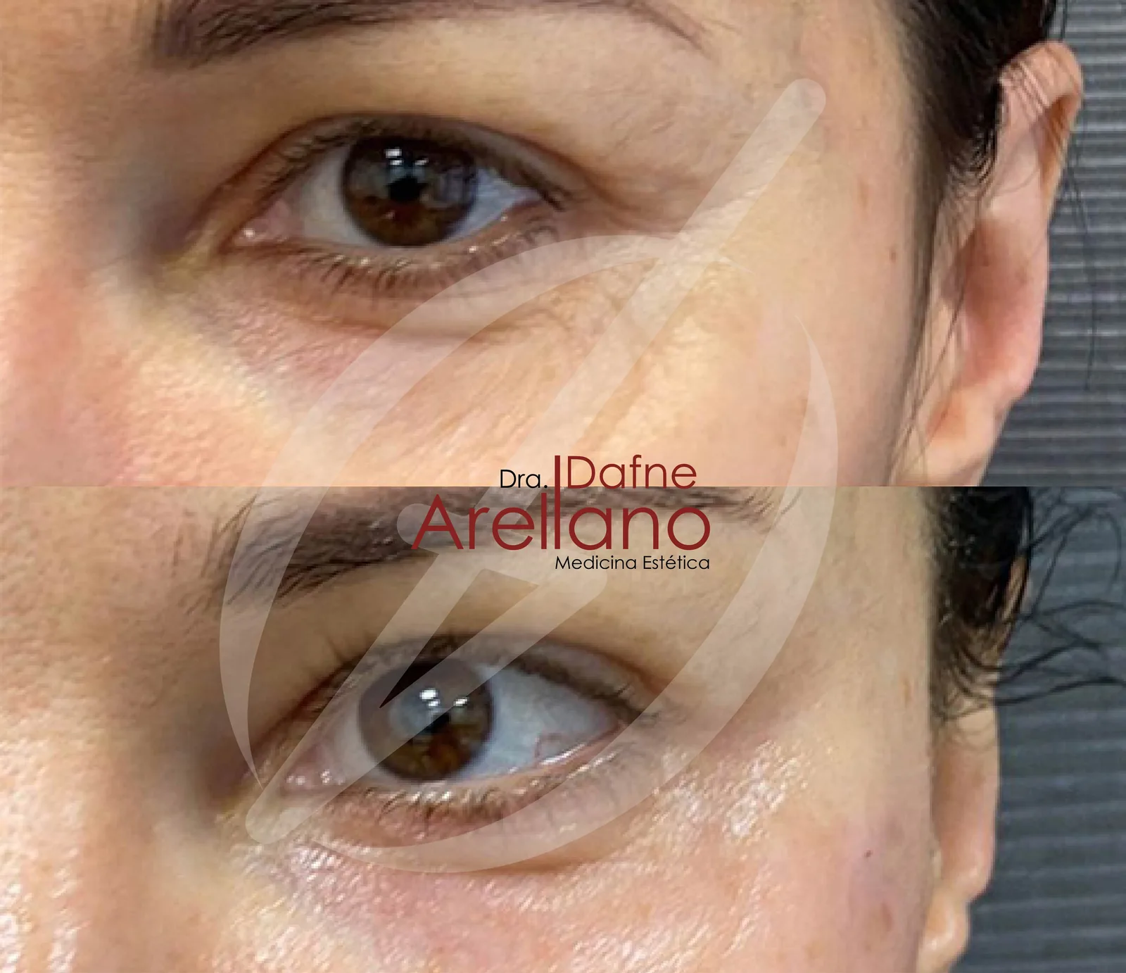 Después — Juvelook en Puebla – Bioestimulador Híbrido