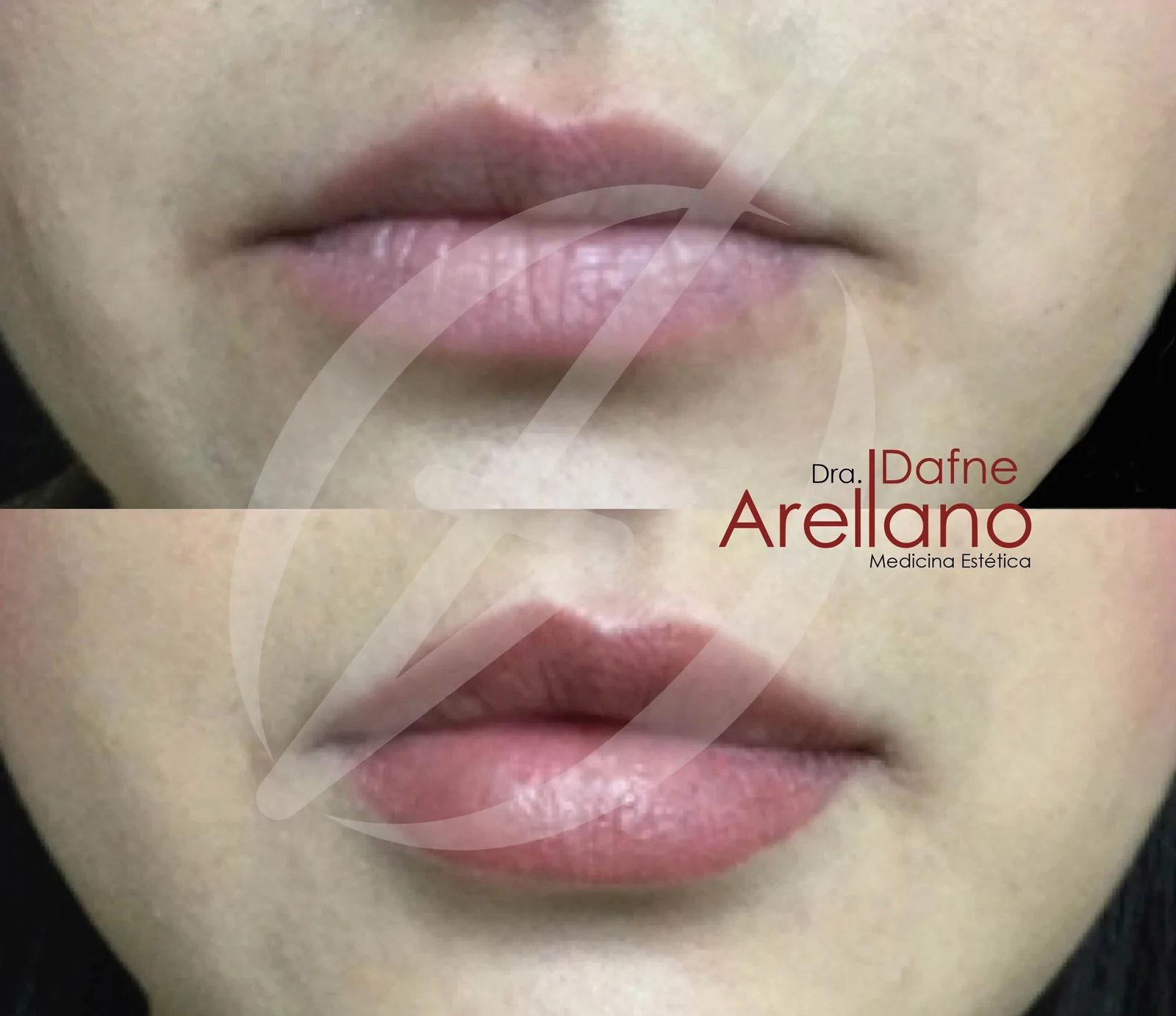 Antes — Aumento de Labios en Puebla