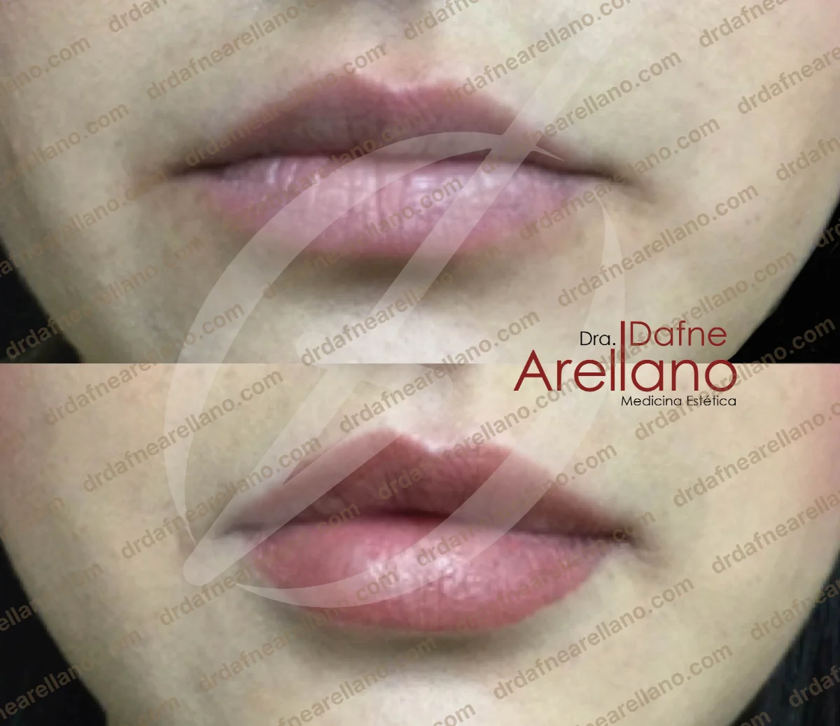 Antes y después — Aumento de Labios en Puebla