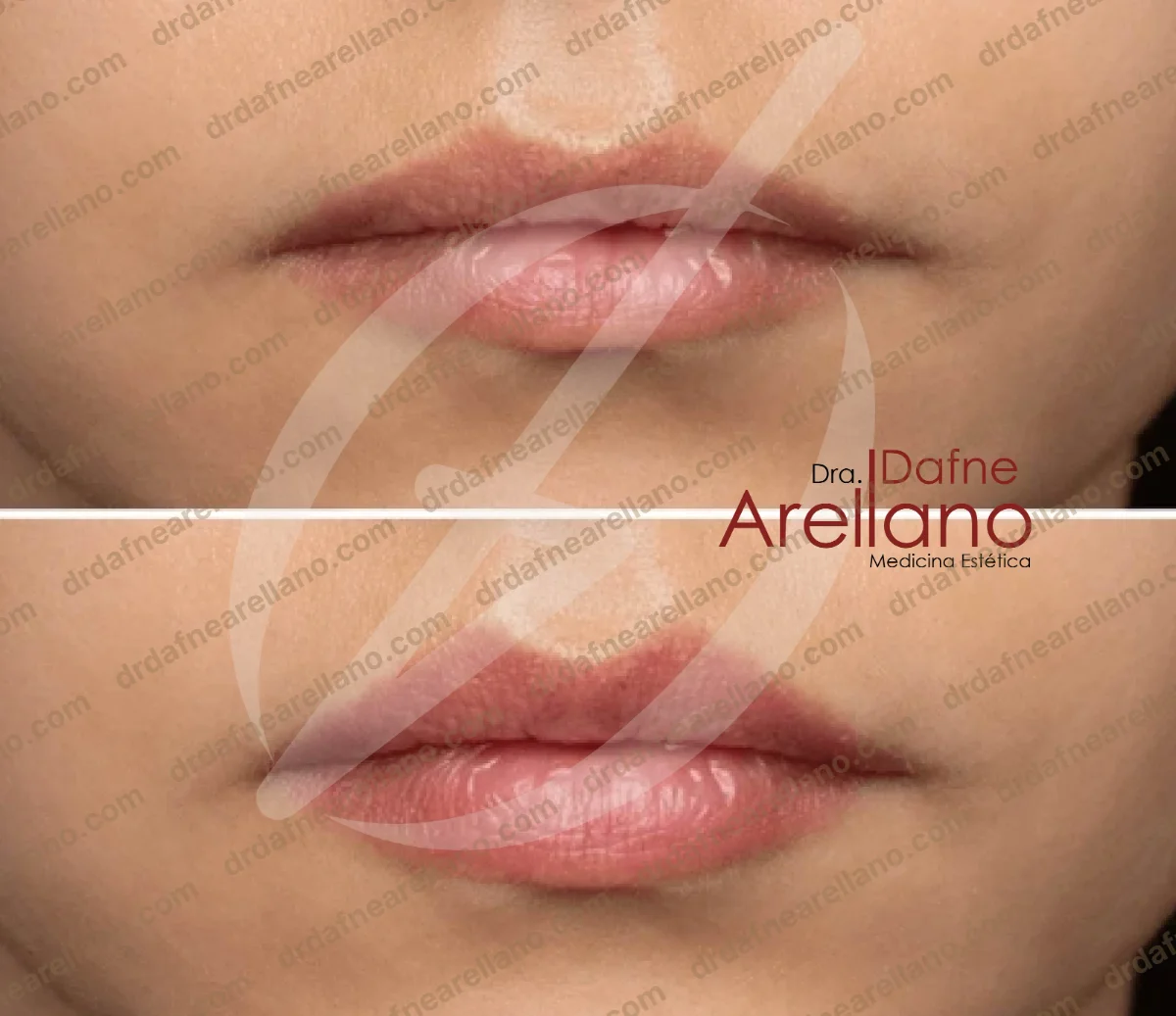 Antes y después — Aumento de Labios en Puebla