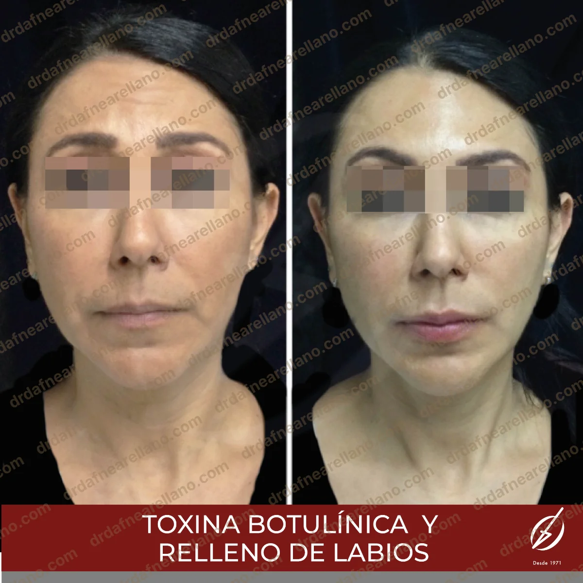 Antes y después — Aumento de Labios en Puebla
