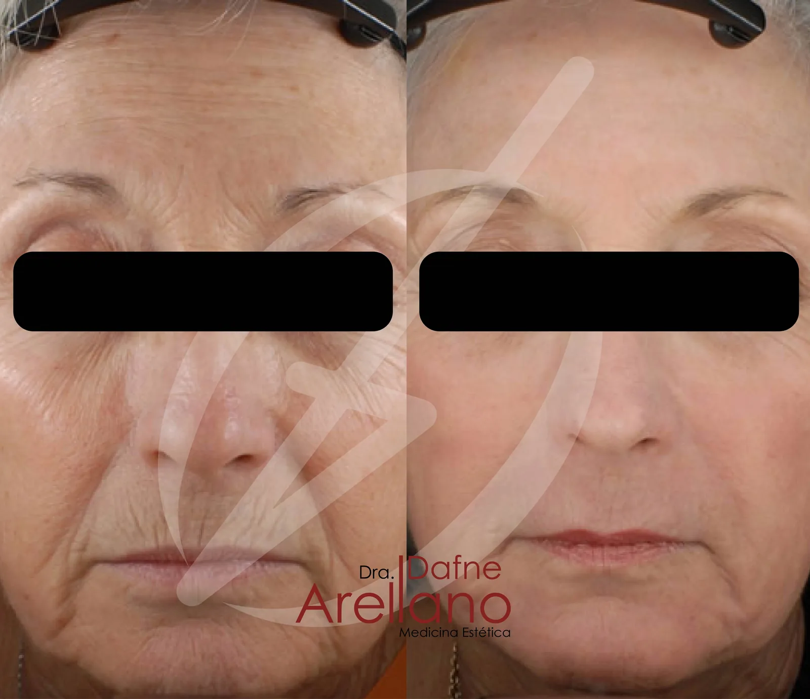 Después — Láser CO₂ Fraccionado en Puebla