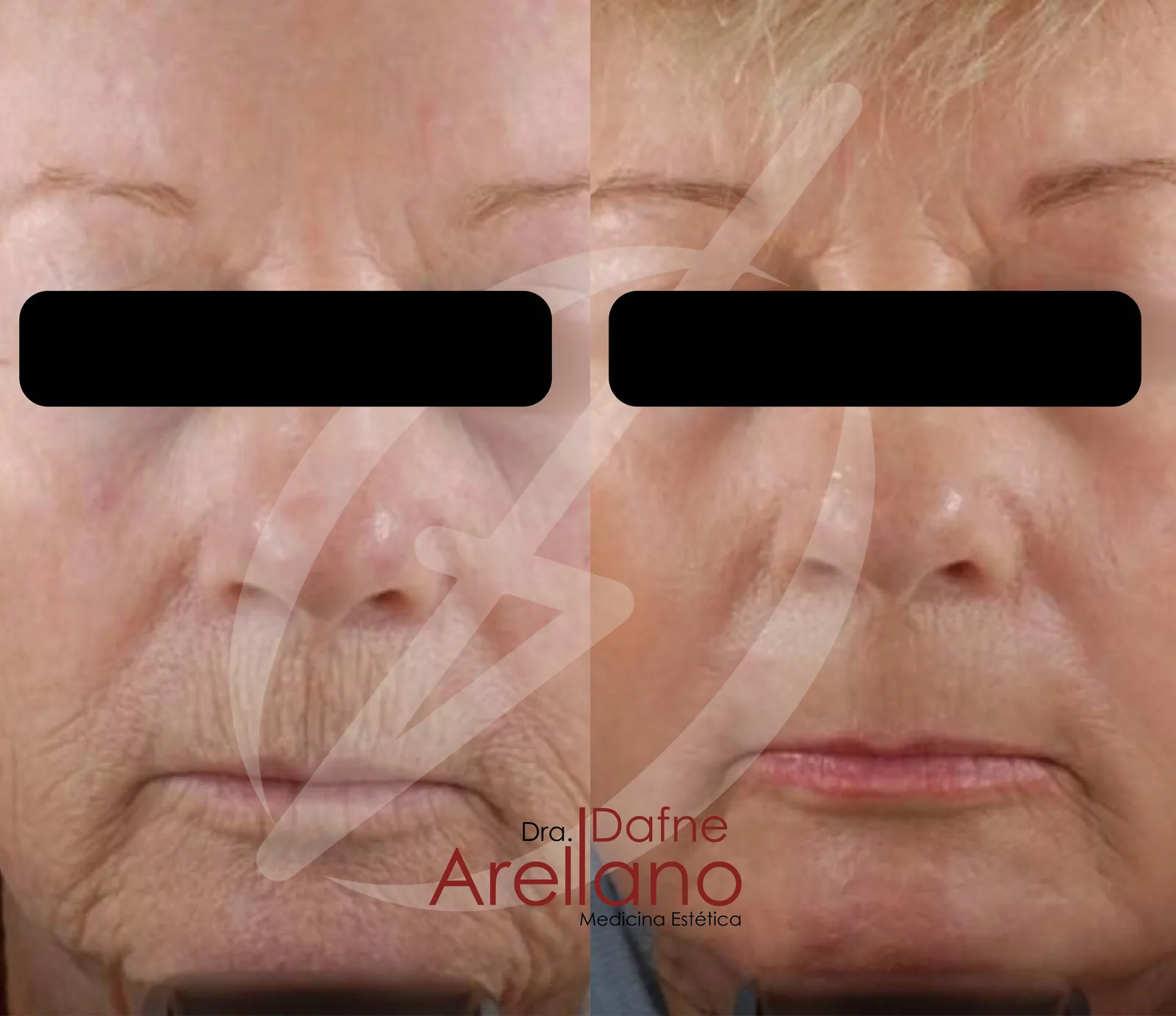 Antes — Láser CO₂ Fraccionado en Puebla