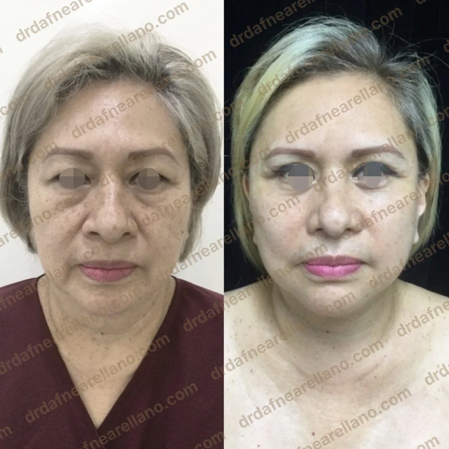 Antes y después — Láser CO₂ Fraccionado en Puebla