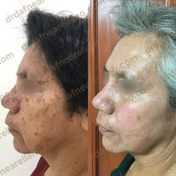 Antes y después — Láser CO₂ Fraccionado en Puebla