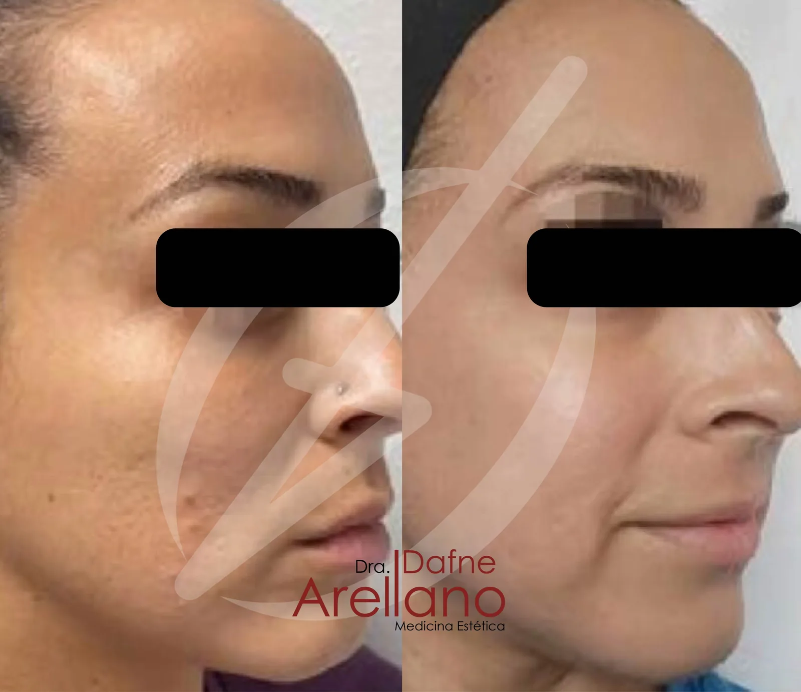 Después — Láser Híbrido Alma Hybrid en Puebla