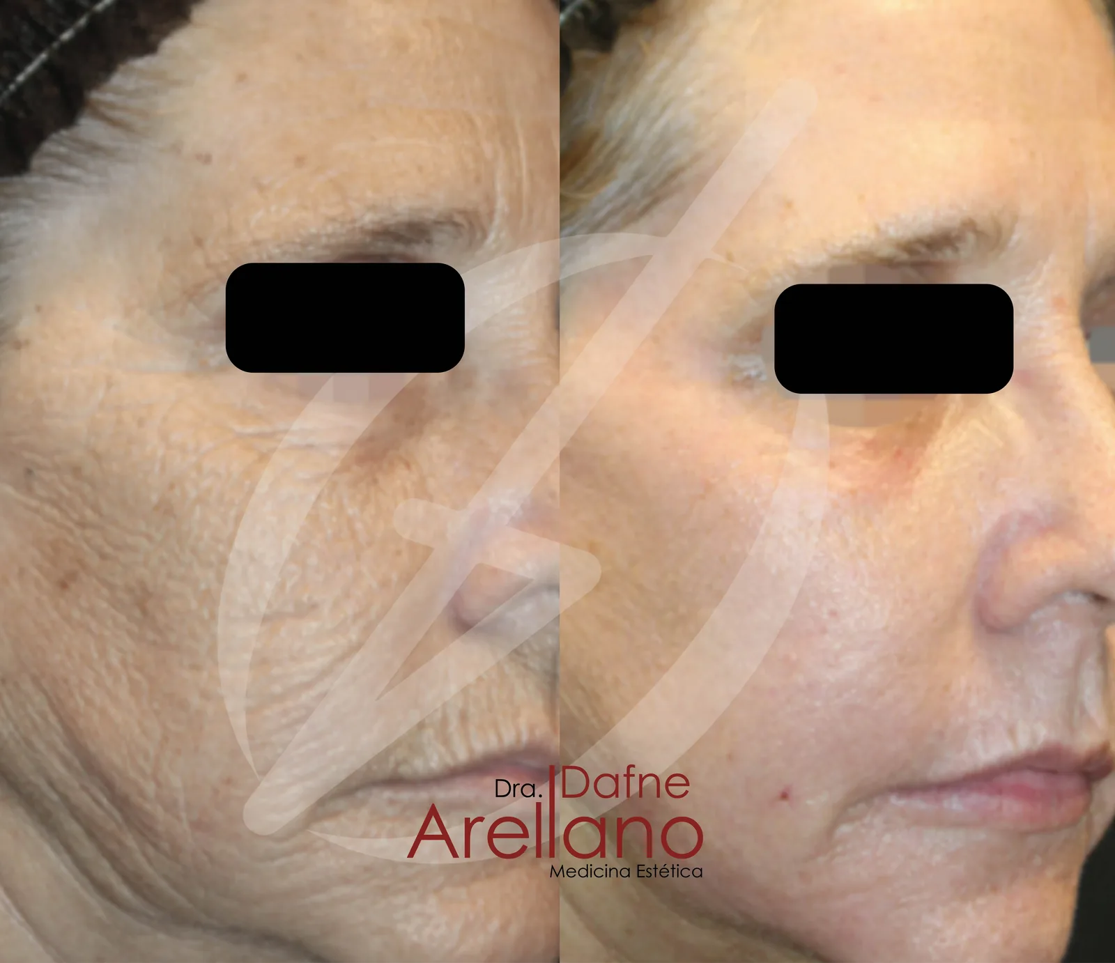 Antes — Láser Híbrido Alma Hybrid en Puebla