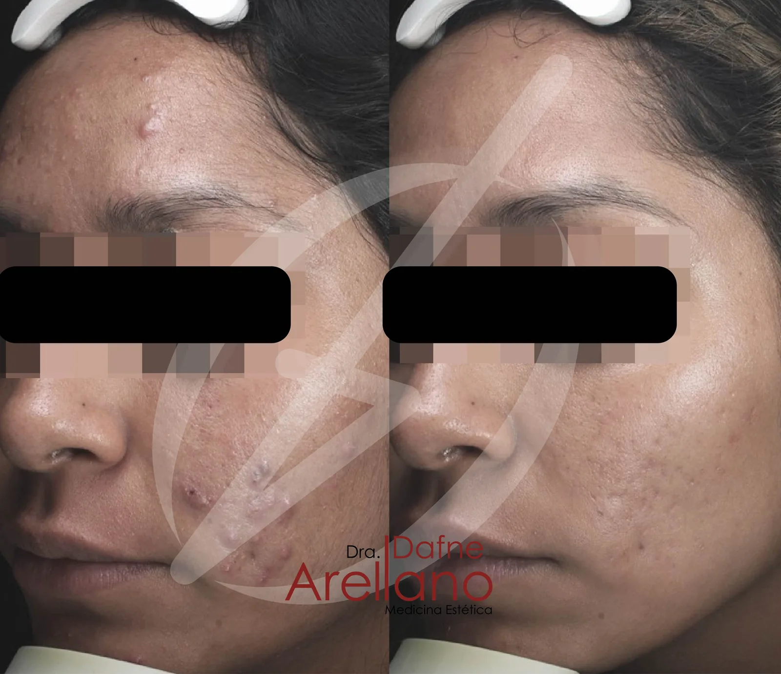 Antes — Light Peelings en Puebla