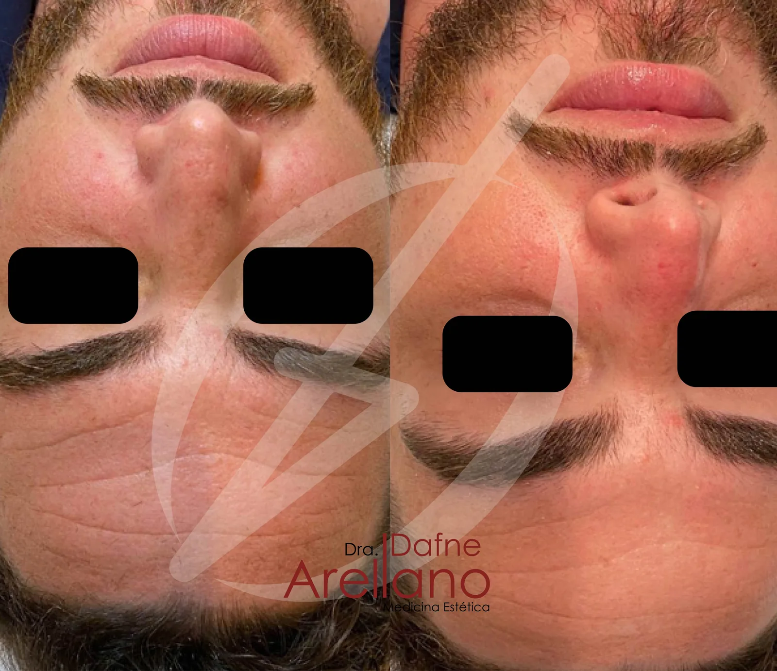 Después — Limpieza Facial Profesional en Puebla