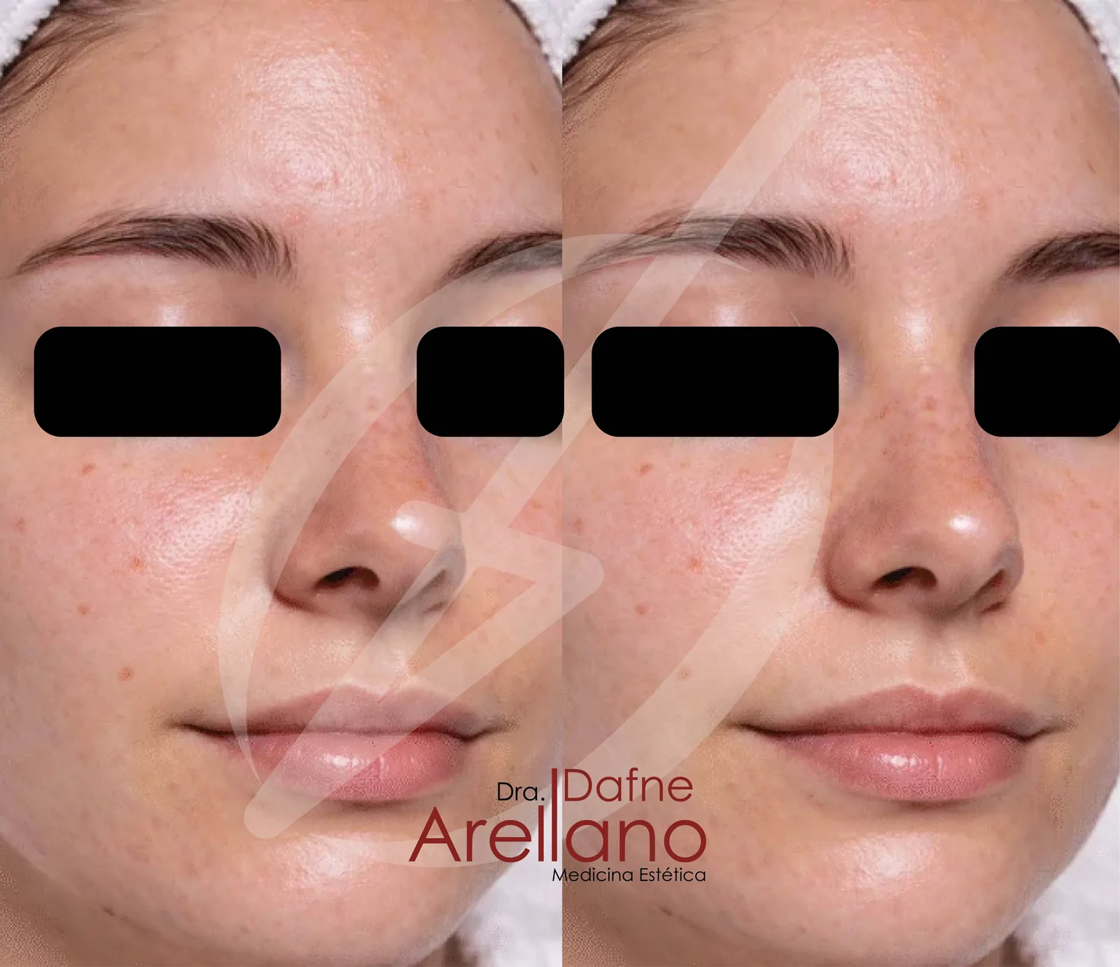 Antes — Limpieza Facial Profesional en Puebla