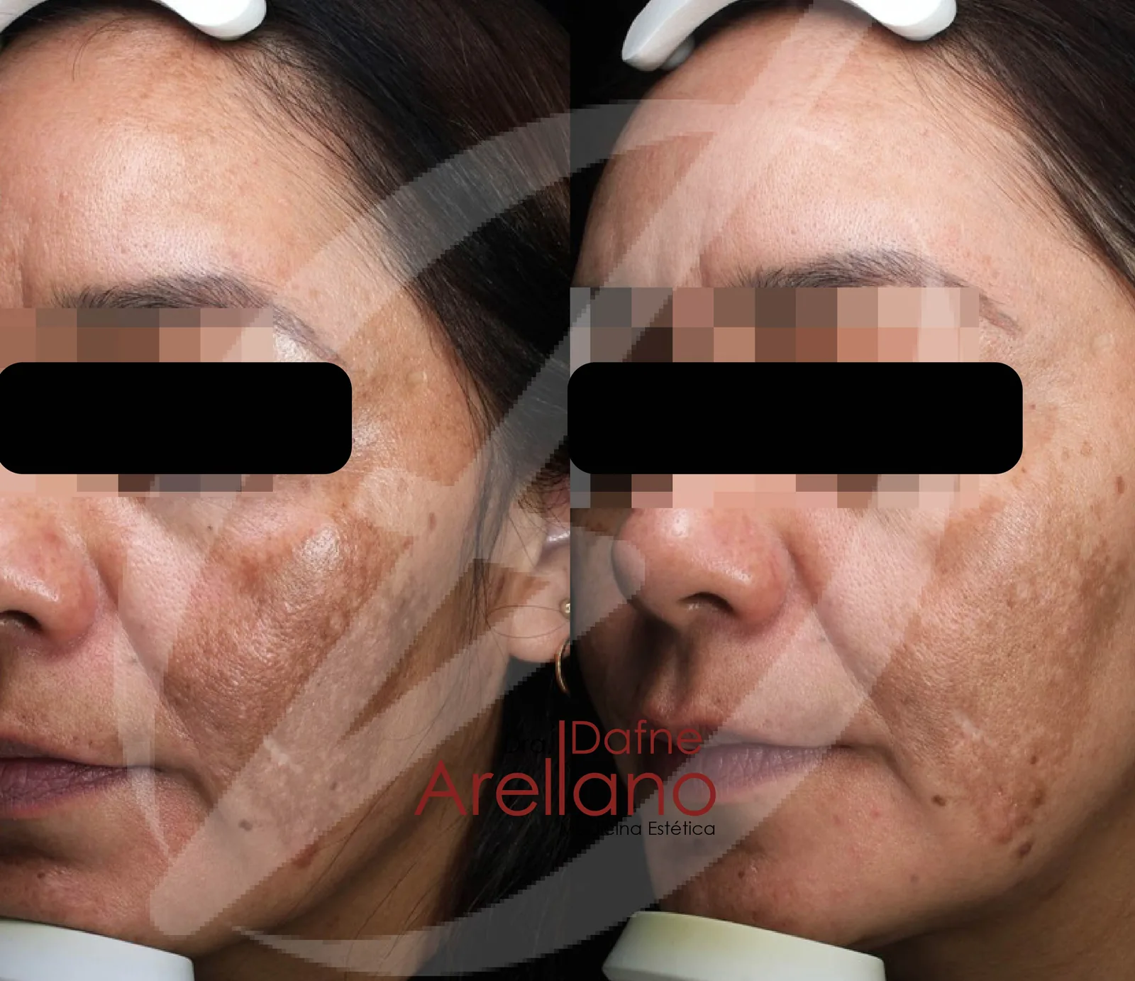 Antes — Tratamiento de Manchas en la Piel en Puebla