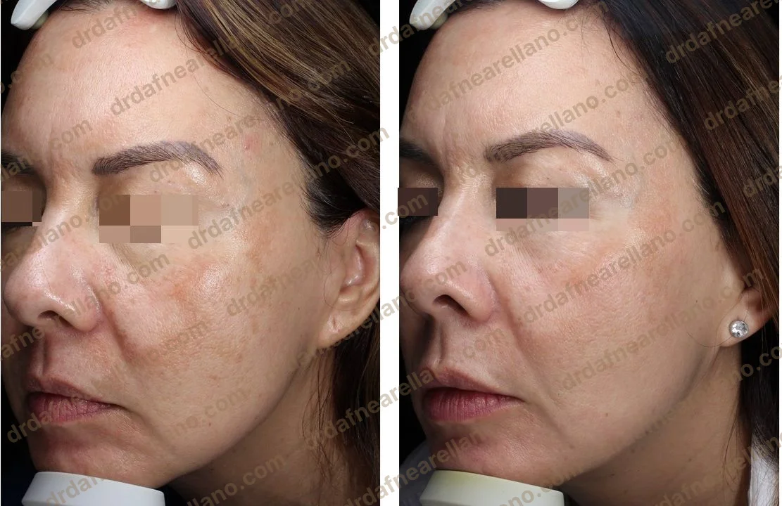 Tratamiento de léntigos solares — antes y después con luz pulsada IPL Lumenis M22 en Puebla