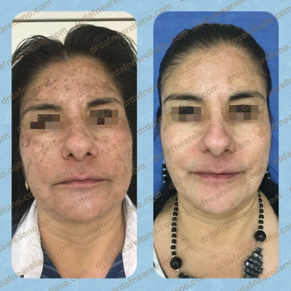 Tratamiento de hiperpigmentación postinflamatoria post-acné — antes y después con peeling químico médico en Puebla