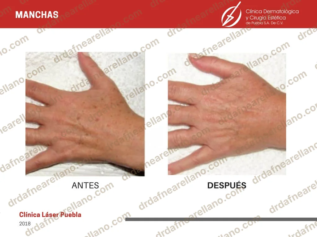 Tratamiento de melasma centrofacial — antes y después con láser ResurFX no ablativo en Puebla