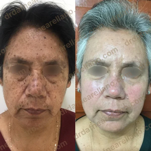 Tratamiento de manchas solares — antes y después con IPL + peeling químico en Puebla