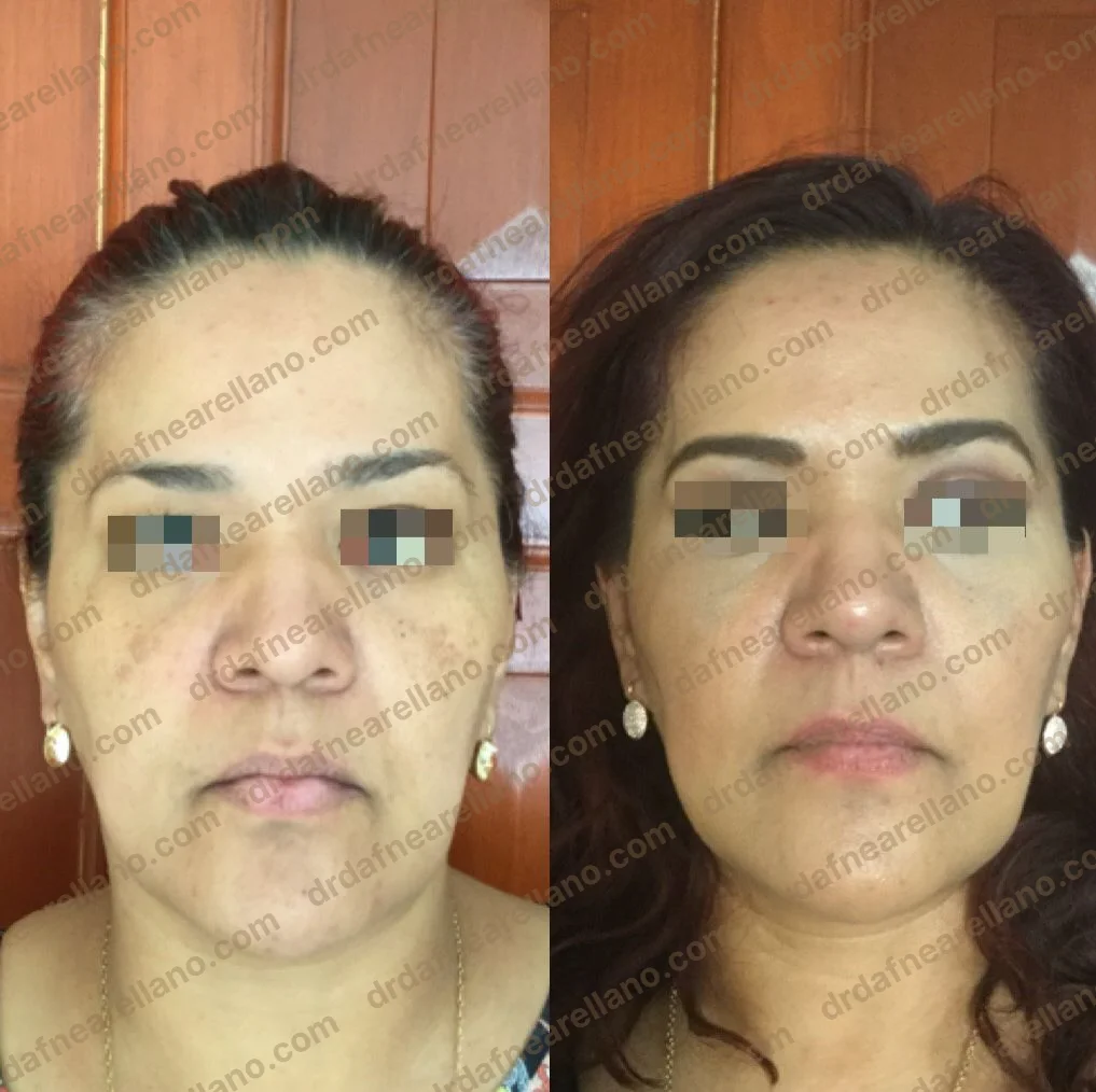 Tratamiento de manchas de edad — antes y después con láser CO2 AcuPulse fraccionado en Puebla