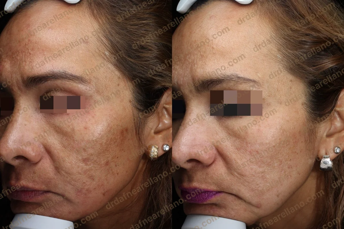 Tratamiento de hiperpigmentación dérmica — antes y después con Cosmelan 6 meses en Puebla