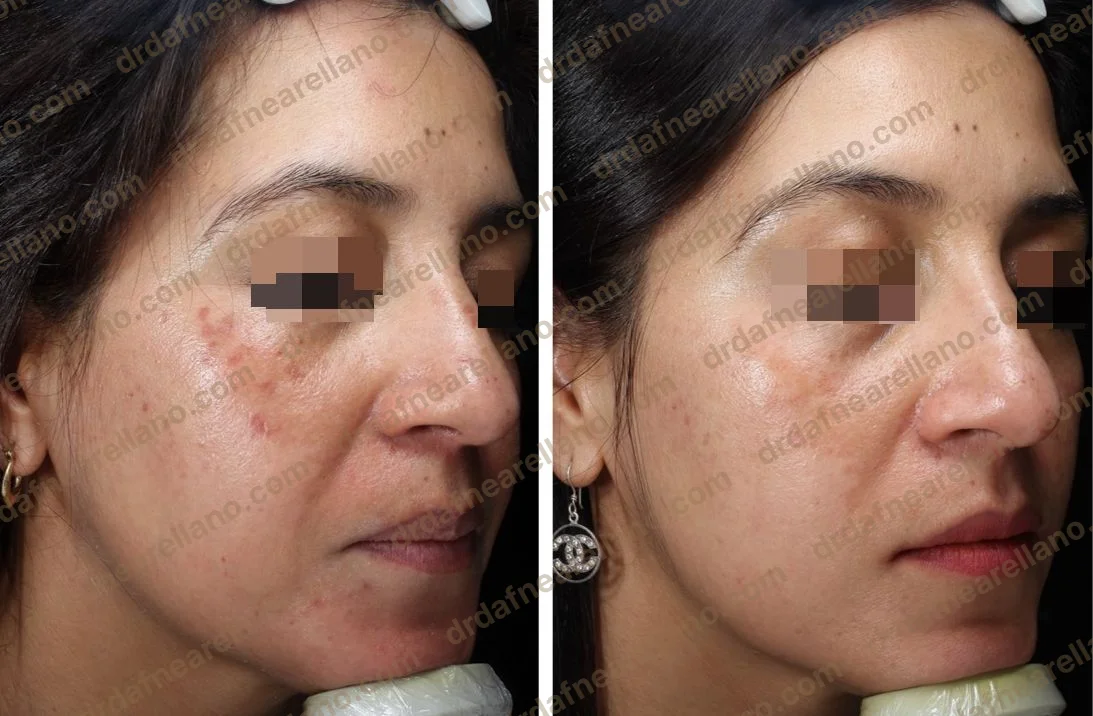 Tratamiento de lentigos seniles — antes y después con luz pulsada en Puebla