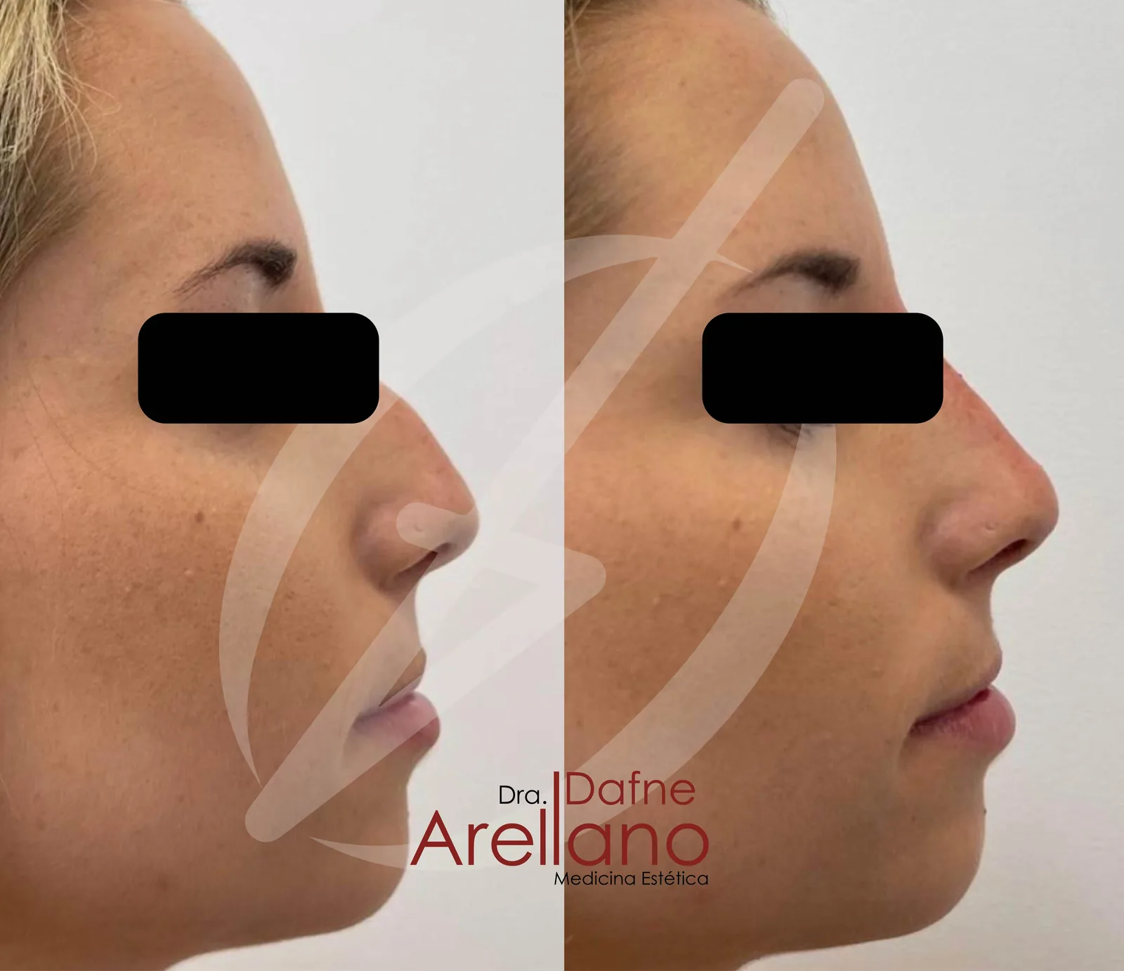 Antes y después · Nctf Hialuronic Pen